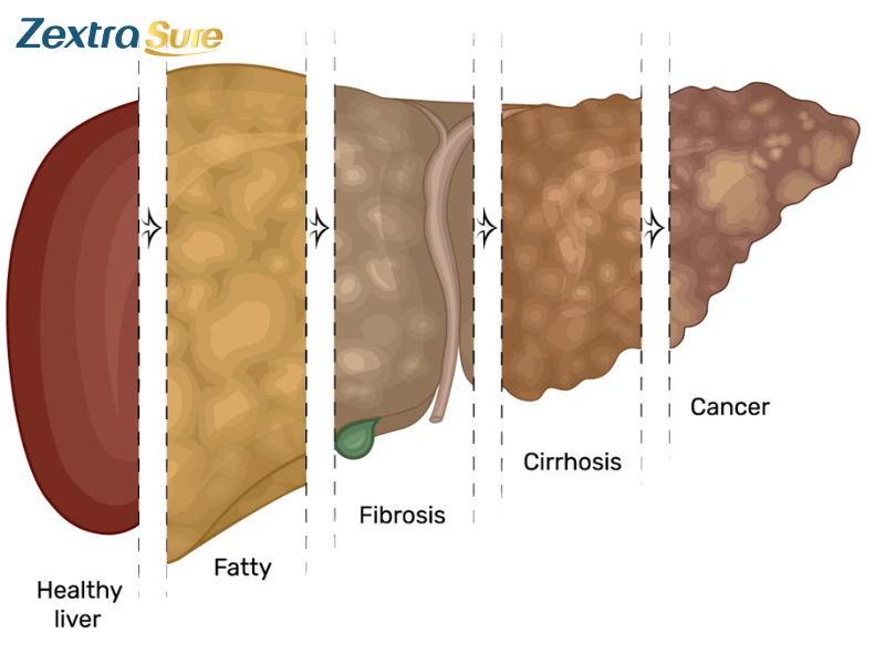 fatty-liver-disease-symptoms-treatment (8)